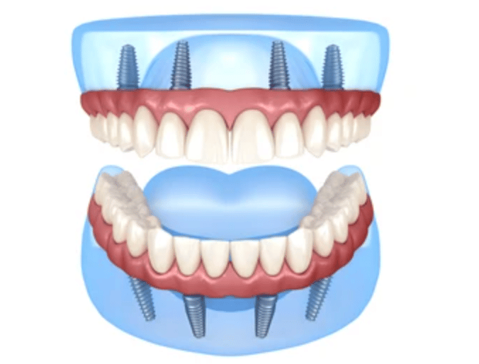 השתלות שיניים ALL ON 4