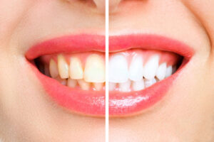 לפני ואחרי ציפוי שיניים קומפוזיט