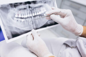 צילום שיניים לפני עקירה כירורגית