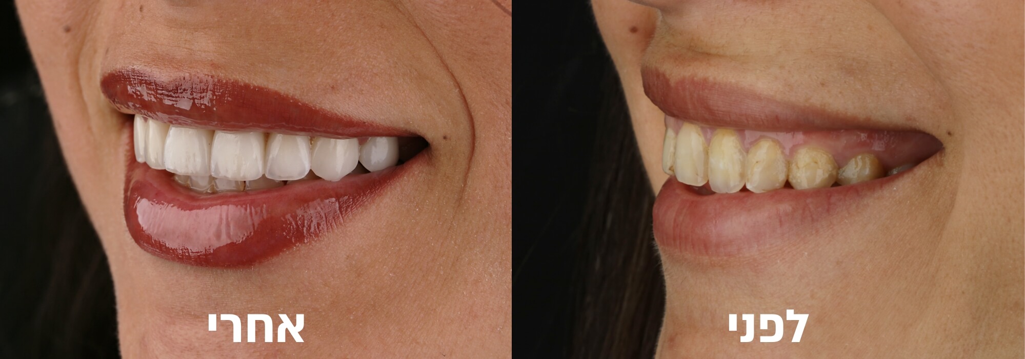 לפני ואחרי ציפוי חרסינה לשיניים