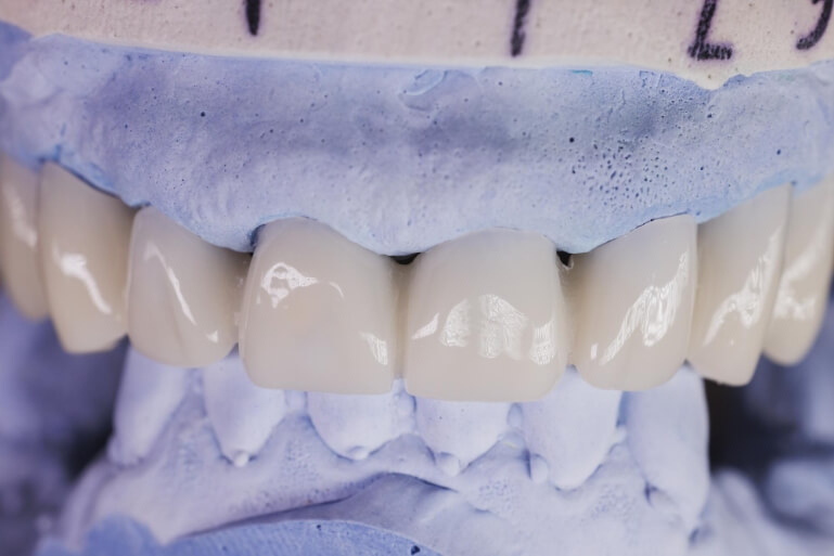הדמיה ציפוי שיניים