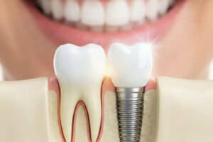 כמה זמן מחזיק שתל שיניים