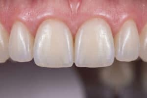 כתרי זירקוניה לשיניים קדמיות