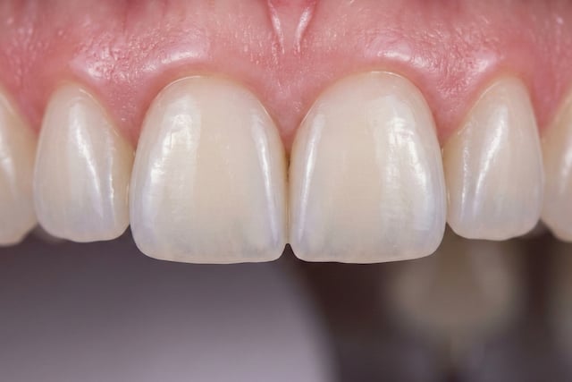 כתרי זירקוניה לשיניים קדמיות